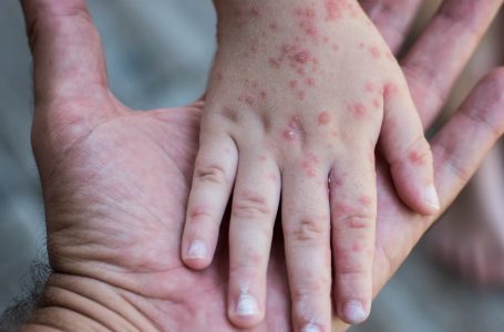 Eventual alerta sanitaria en la ciudad de Puebla