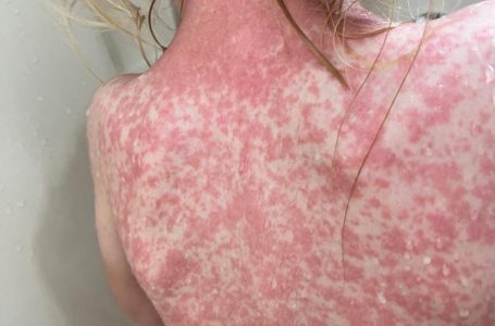 Nueva crisis sanitaria por sarampión